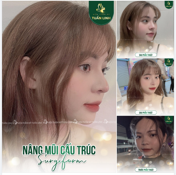 NÂNG MŨI CẤU TRÚC SURGIFORM - MỀM MẠI - ĐẸP TỰ NHIÊN!!