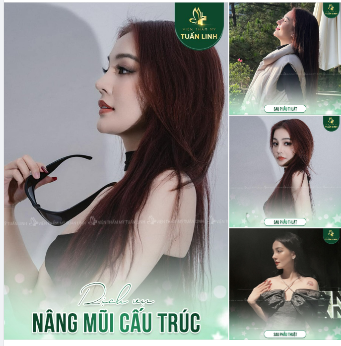 Chọn phương pháp nâng mũi phù hợp - Tái tạo dáng mũi ''đỉnh chóp''