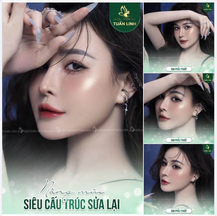 Nâng mũi siêu cấu trúc sửa lại - Sang chảnh, thời thượng, cá tính