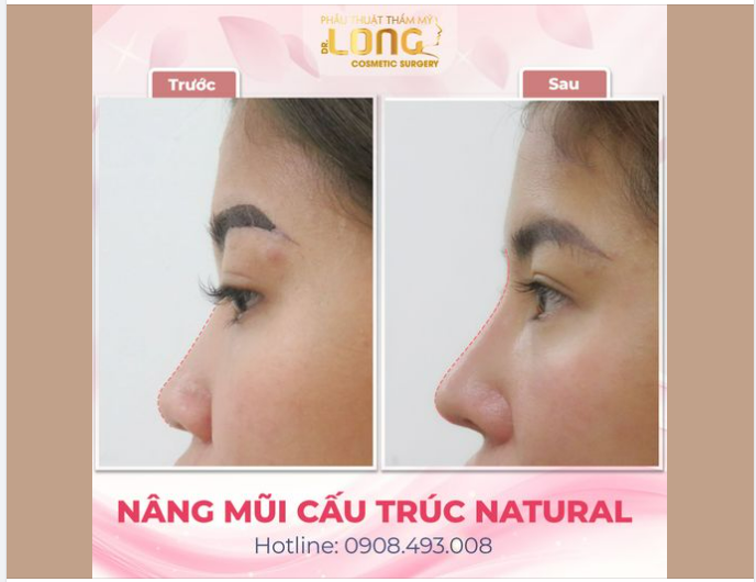 THIẾU TỰ TIN - KHI DÁNG MŨI CHƯA XINH