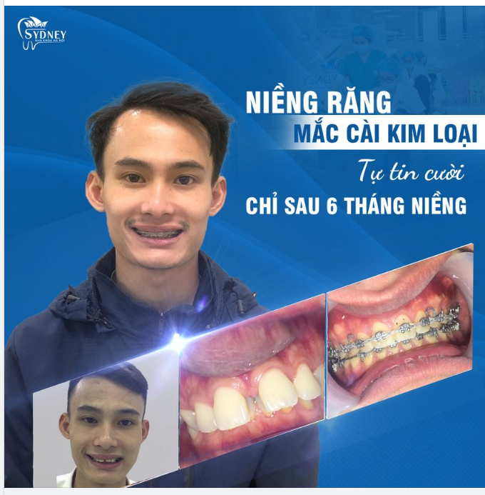Khắc phục răng thưa bằng niềng răng chỉ 670k/tháng