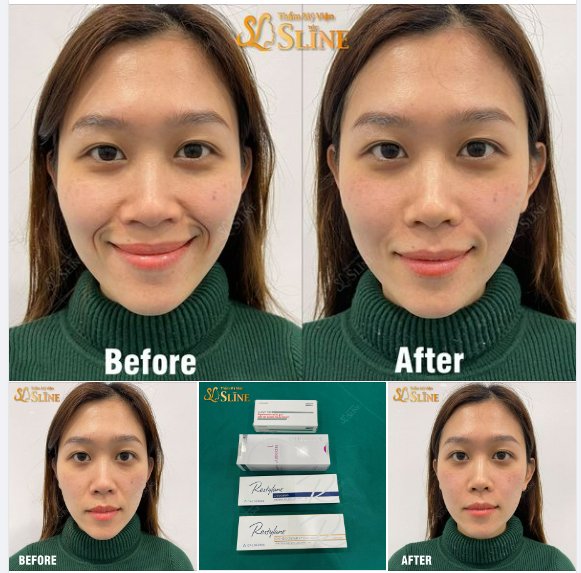ĐỘN CẰM  TẶNG MIỄN PHÍ XÓA RÃNH CƯỜI