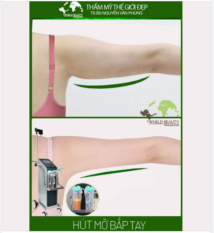 Hình ảnh thay đổi vùng bắp tay của Khách hàng sau ph.ẫu th.uật hút bằng công nghệ Body-Jet-Evo!