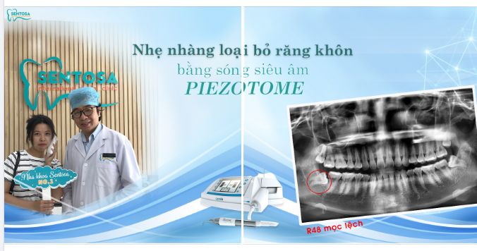 KHÁCH HÀNG NÓI GÌ VỀ VIỆC NHỔ RĂNG KHÔN BẰNG MÁY PIEZOTOME TẠI SENTOSA?