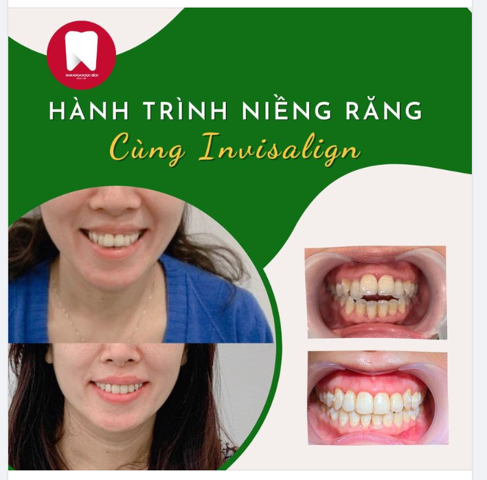 NỤ CƯỜI MỚI SAU HƠN 1 NĂM ĐỒNG HÀNH CÙNG INVISALIGN