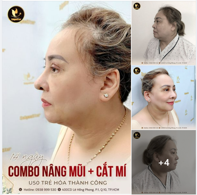 COMBO NÂNG MŨI + CẮT MÍ MẮT U50 TRẺ HÓA THÀNH CÔNG