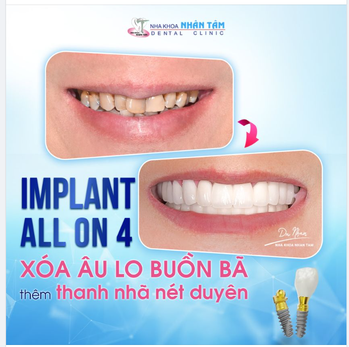 CẤY GHÉP IMPLANT THÀNH CÔNG TUYỆT ĐỐI CHO NGƯỜI CÓ BỆNH LÝ Y KHOA