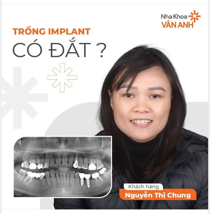 TRỒNG IMPLANT CÓ ĐẮT KHÔNG?