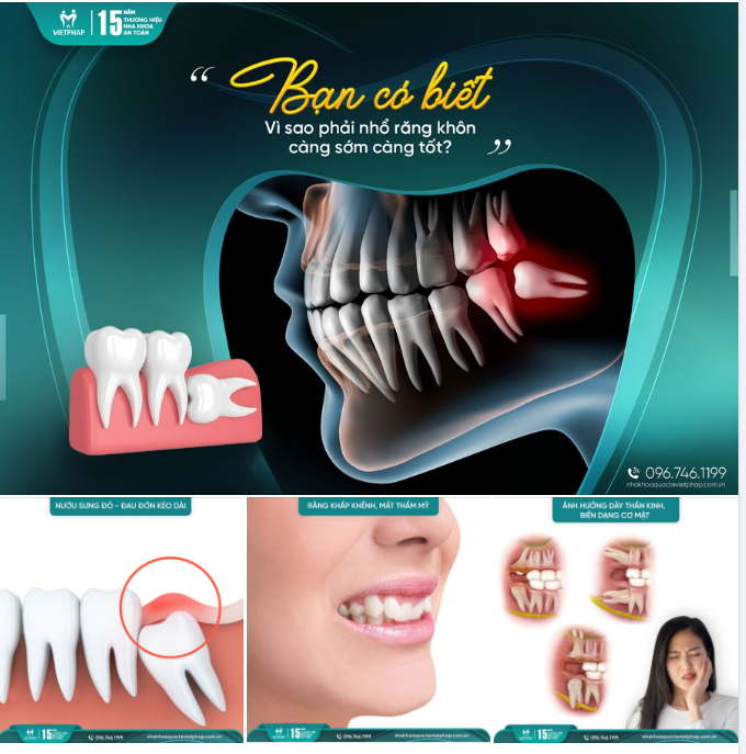 VÌ SAO NÊN NHỔ RĂNG KHÔN CÀNG SỚM CÀNG TỐT?