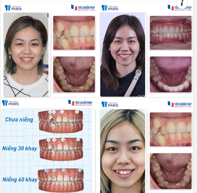Niềng Răng Trong Suốt Có Hiệu Quả?