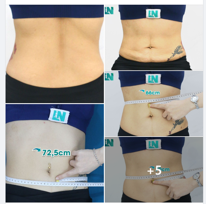  HÚT MỠ TẠO DÁNG THẨM MỸ CHO CHỊ KH ĐẾN TỪ ĐỒNG NAI