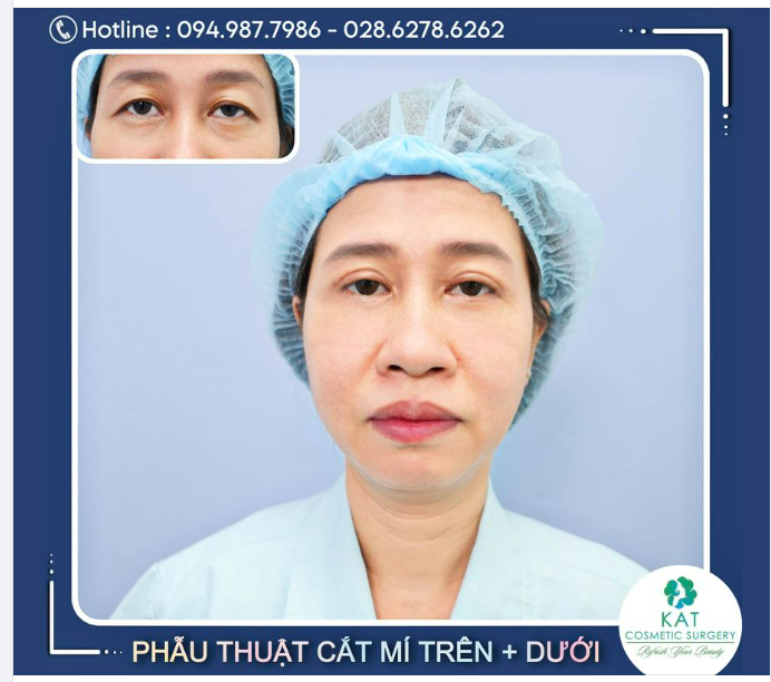 “Trả lại nét thanh xuân cho đôi mắt “