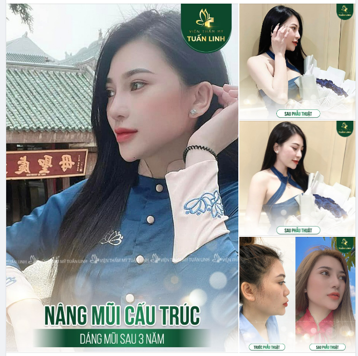 Feedback khách hàng - Nâng mũi cấu trúc sau 3 năm