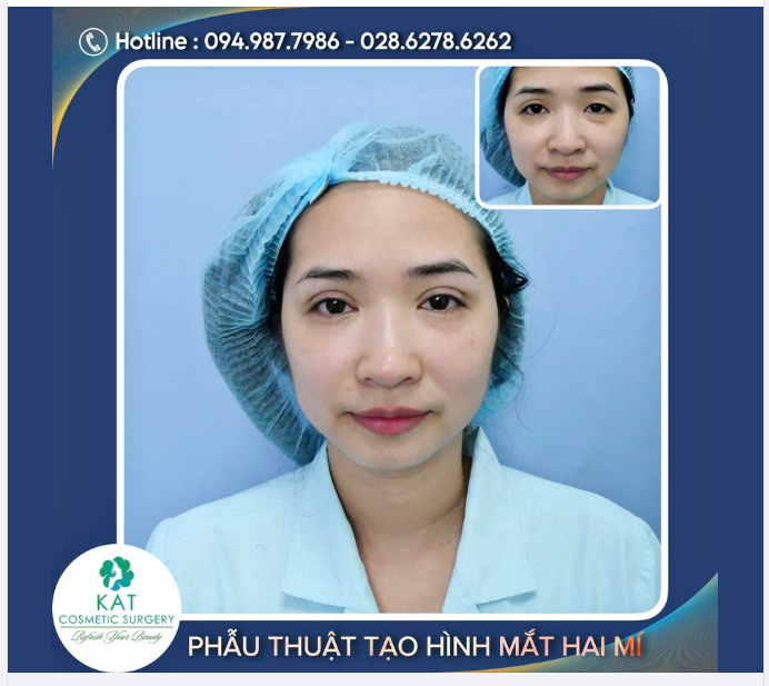 Hình ảnh chụp ngay sau phẫu thuật từ khách hàng thực tế tại KAT