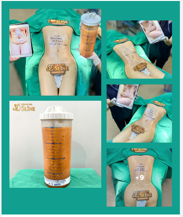 “Bạn chị vừa thực hiện Hút mỡ siết eo 360 bên em, chị đến thăm thấy đẹp quá nên quyết định làm luôn để đẹp luôn”