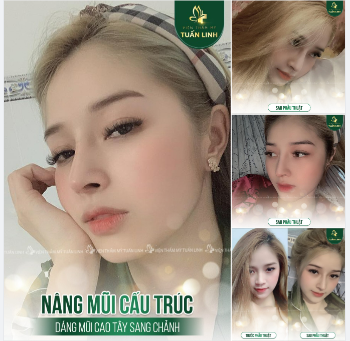 5 lí do khách hàng lựa chọn nâng mũi cấu trúc tại TMV Tuấn Linh 