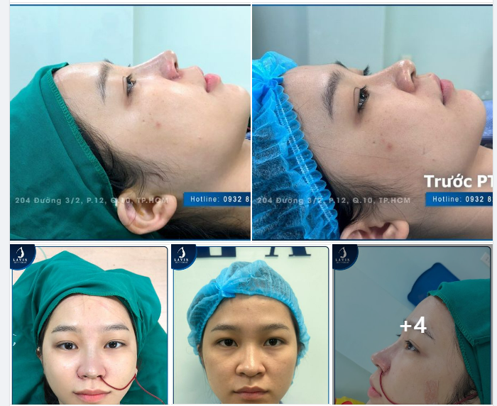 KẾT QUẢ NÂNG MŨI NHƯ Ý CHO EM GÁI KHÁCH HÀNG DỄ THƯƠNG