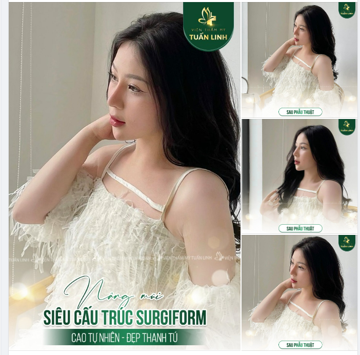 Bạn nào thích dáng mũi mềm mại tự nhiên thì tham khảo ngay dáng mũi cấu trúc Surgiform này nhà Tuấn Linh nha.
