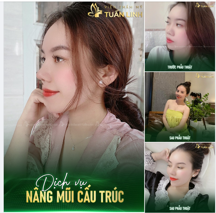 Đến Tuấn Linh ngay, để biến mũi cao xinh đẹp thành sự thật!!!