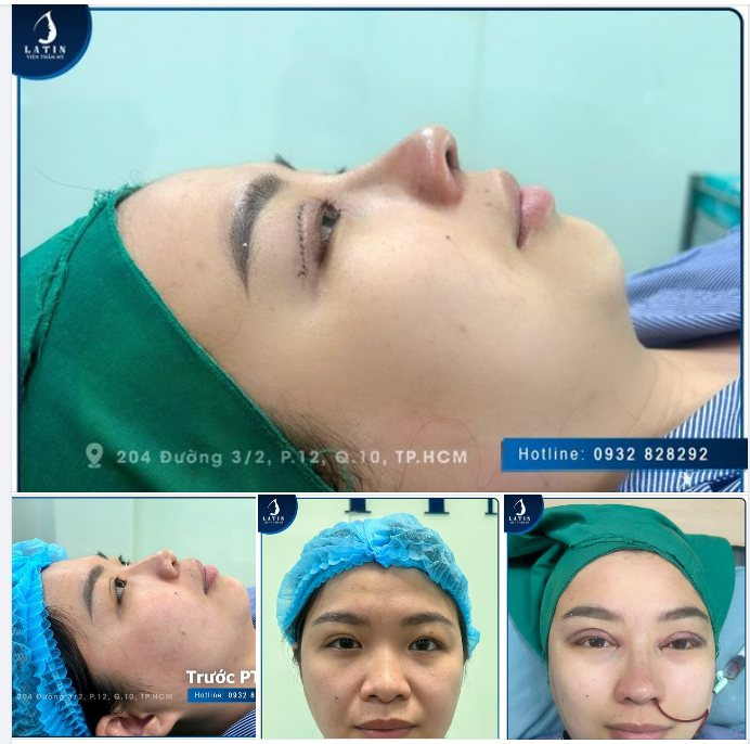 Khách hàng đến từ An Giang thay đổi ngoạn mục sau combo làm đẹp tại Latin