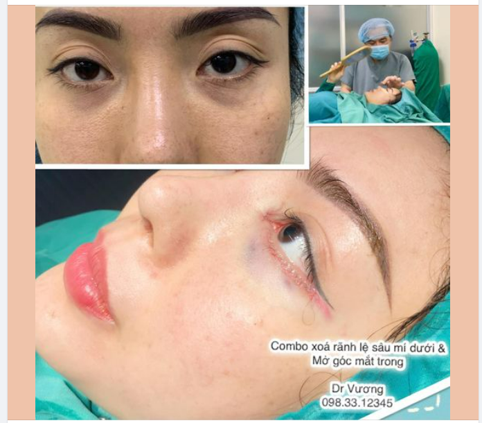 Trẻ hoá vùng mí dưới xoá nếp rẻ quạt góc mắt trong cho bạn gái đến từ Tp Thủ Đức