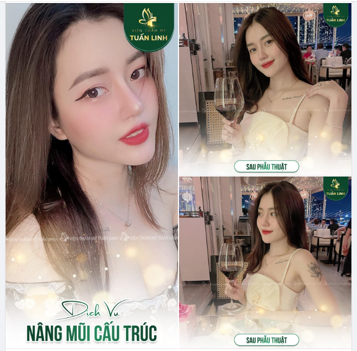 Diện mạo xinh đẹp của khách hàng nhà Tuấn Linh sau 3 năm nâng mũi cấu trúc!!