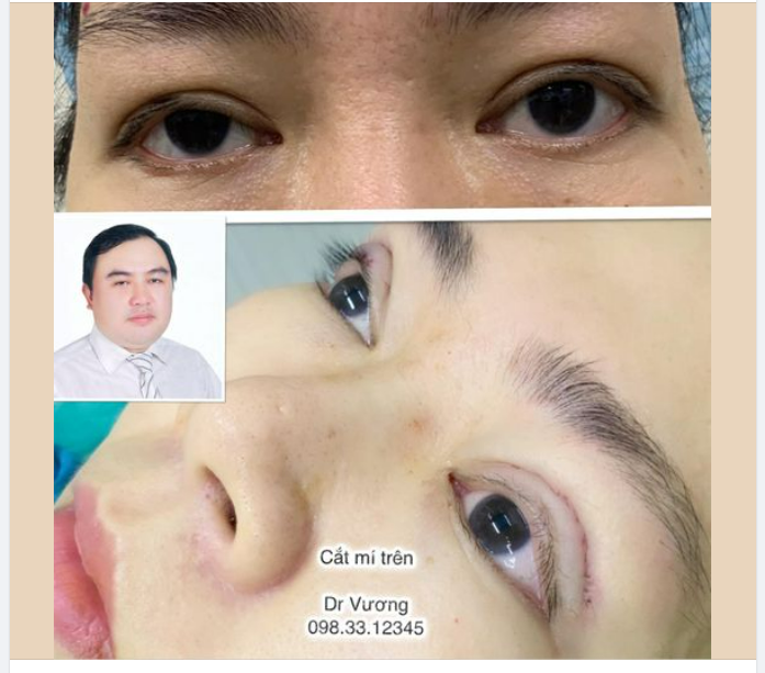 Xử trí da chùng, mỡ dư, mí trên sụp = Combo cắt mí trên với Dr Vương