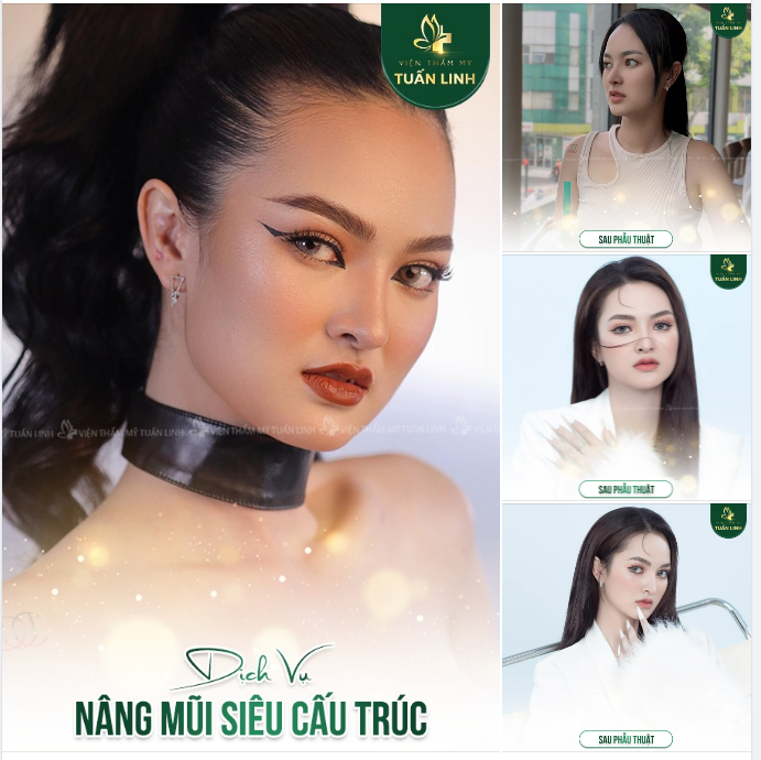 Nâng Mũi 3 KHÔNG tại Tuấn Linh!!