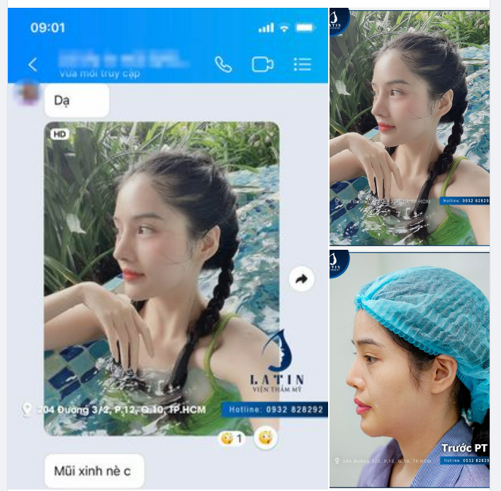MŨI ĐẸP CHỈ SAU 15 NGÀY NÂNG MŨI