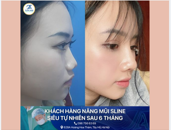 FORM MŨI XINH VẠN NGƯỜI MÊ