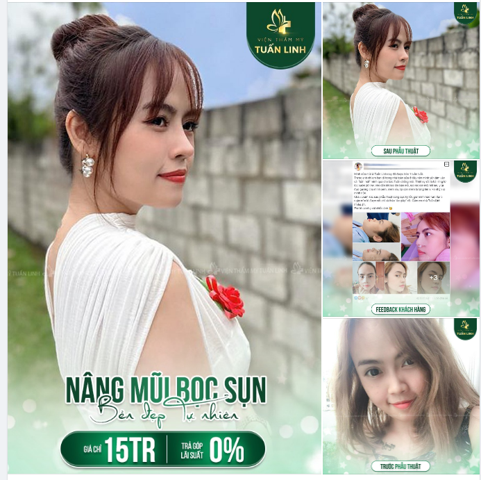 Nâng mũi bền đẹp tự nhiên. Chọn ngay nâng mũi bọc sụn