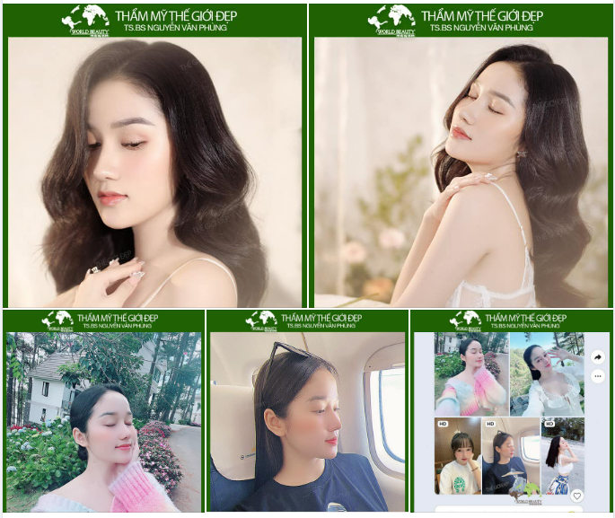 Từng 2 lần n.âng cấp mũi không vừa ý, quý Cô tìm đến giải pháp tái cấu trúc mũi lần thứ 3 bằng sụn tự thân và Surgiform.