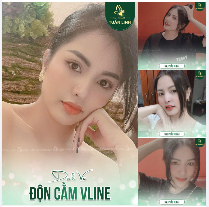 ĐỘN CẰM VLINE - KHUÔN MẶT CÂN ĐỐI - XINH SANG VÔ ĐỐI