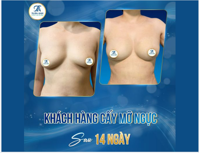 NÂNG NGỰC BẰNG CẤY MỠ TỰ THÂN - TẠI SAO KHÔNG?