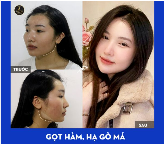 THỜI GIAN THẤM THOẮT THOI ĐƯA...MỚI ĐÓ MÀ ĐÃ 3 NĂM GỌT HÀM, HẠ GÒ MÁ