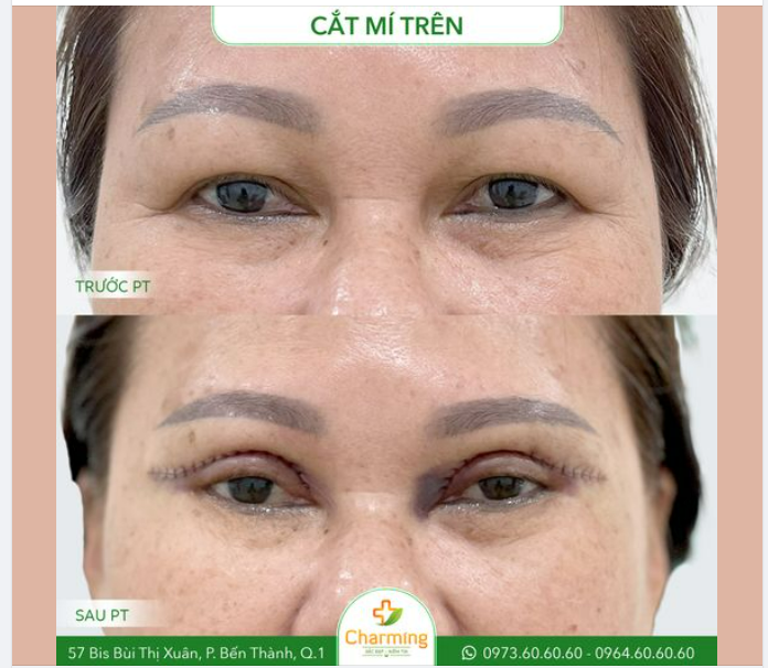 Ánh nhìn cứng đờ, thiếu sức sống khi mí mắt sụp xuống, lấn đi làn mí thuở ban đầu cũng là một ảnh hưởng mà tuổi tác mang đến cho bạn khi nó đã đi qua tuổi 40.