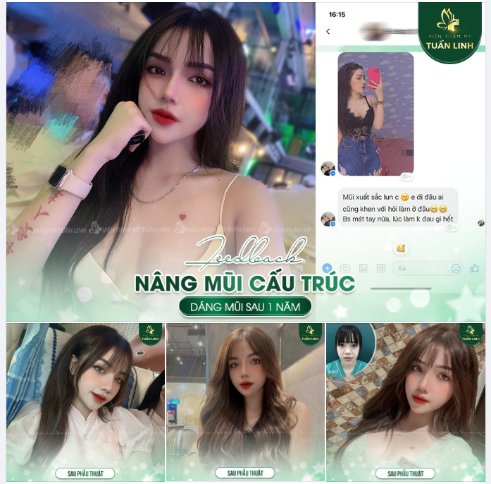 Feedback khách hàng - Nâng mũi cấu trúc sau 1 năm