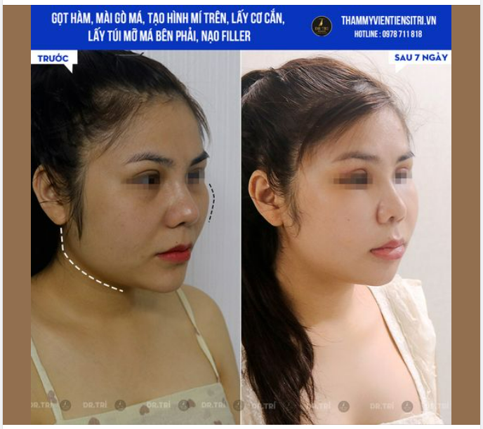 QUYẾT TÂM CHƠI LỚN - MỘT LẦN TRÙNG TU NHAN SẮC ĐỂ ĐẸP TOÀN DIỆN