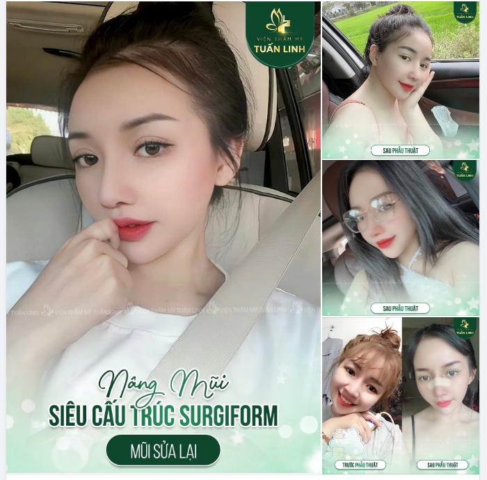 Muốn dáng mũi bền đẹp Chọn ngay nâng mũi siêu cấu trúc sụn Surgiform tại Tuấn Linh nha!