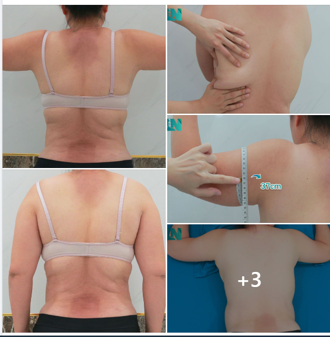 HÚT MỠ TẠO DÁNG THẨM MỸ VÙNG CÁNH TAY, LƯNG, NỌNG CẰM KẾT HỢP  CẤY MỠ TRẺ HOÁ BÀN TAY CHO CHỊ KH 7X, ĐÃ HÚT MỠ BỤNG TẠI EKIP 8 THÁNG TRƯỚC. 