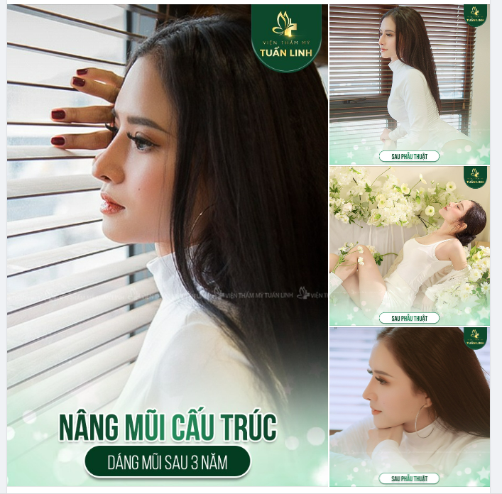 NÂNG MŨI CẤU TRÚC - DÁNG MŨI SAU 3 NĂM