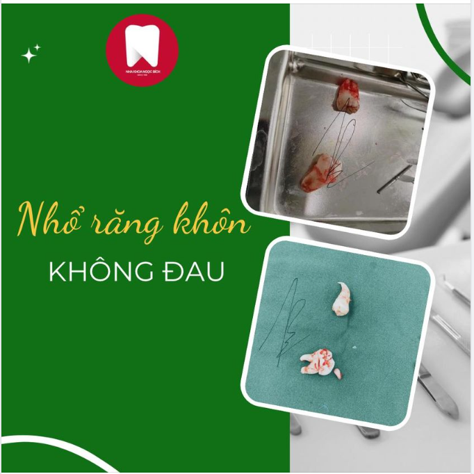 Giải quyết dứt điểm nỗi đau  RĂNG KHÔN chỉ từ 500k