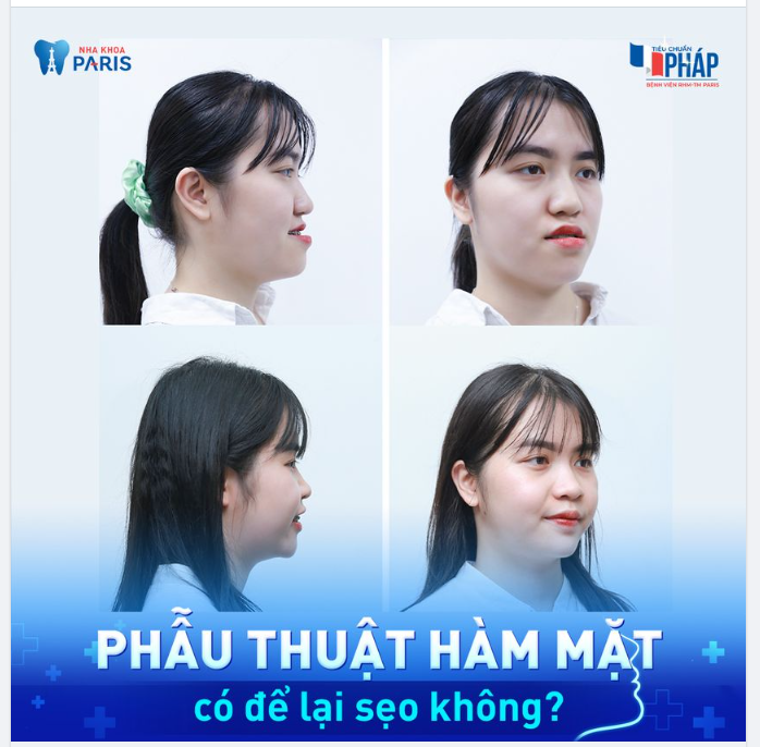 PHẪU THUẬT HÀM MẶT CÓ ĐỂ LẠI SẸO KHÔNG?
