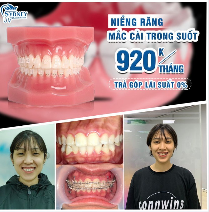Khớp cắn chuẩn là như thế nào?