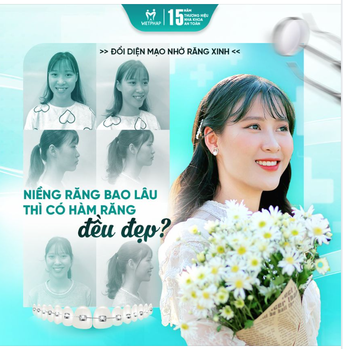 Niềng răng bao lâu thì có hàm răng đều đẹp???