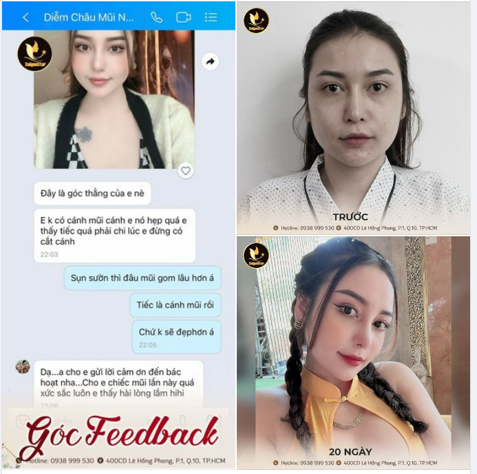GÓC FEEDBACK: NÂNG MŨI CẤU TRÚC 20 NGÀY
