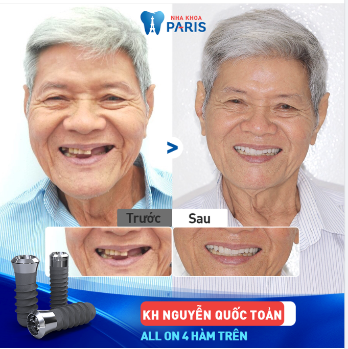CHÚ TOẢN - MẤT NHIỀU RĂNG HÀM TRÊN, ĂN NHAI KHÓ PHẢI LÀM SAO?