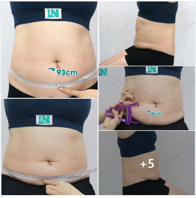  HÚT MỠ TẠO DÁNG THẨM MỸ CHO CHỊ KH 7X, TÌM LẠI DÁNG VÓC GỌN THON THỜI THANH XUÂN. 