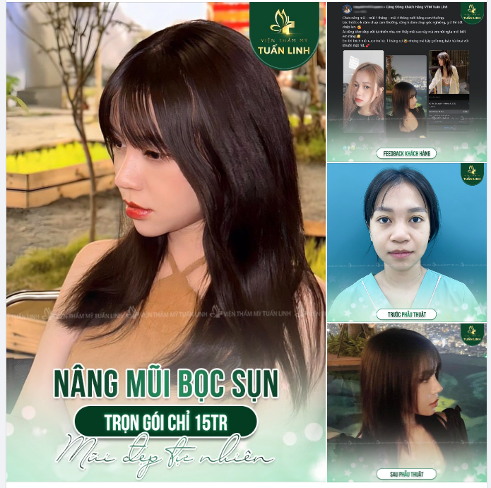 NÂNG MŨI BỌC SỤN - GIÁ TRỌN GÓI CHỈ 15TR