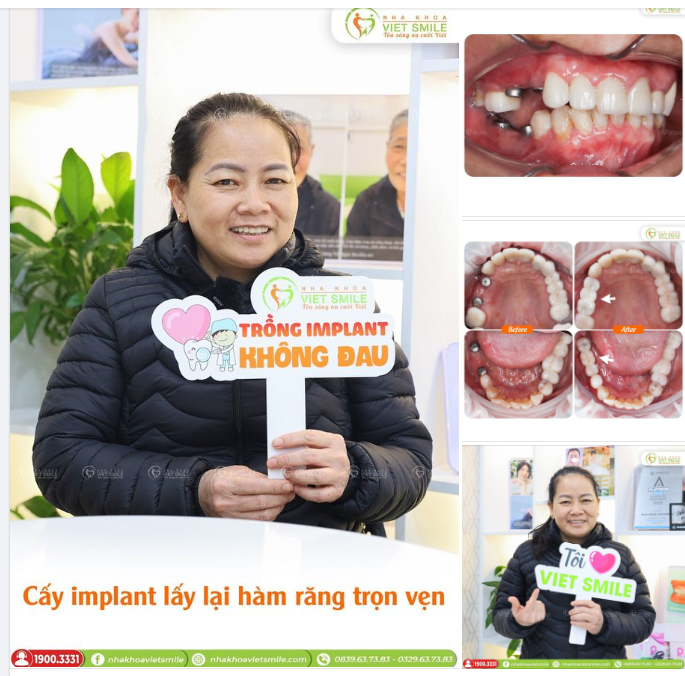 CẤY IMPLANT LẤY LẠI HÀM RĂNG TRỌN VẸN, ĂN NHAI THOẢI MÁI